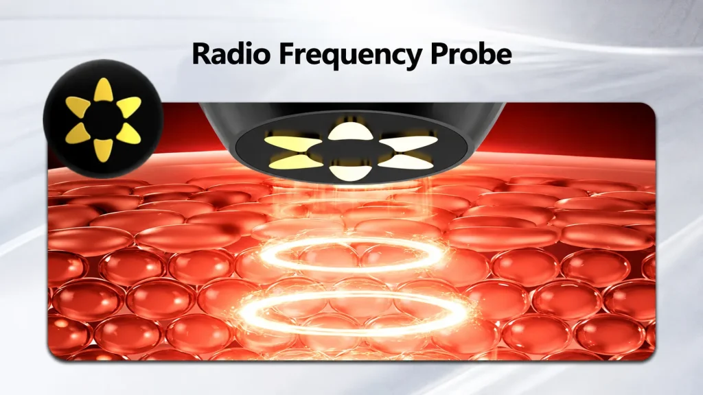 Radio frequency probe working on skin cells, thermal energy stimulates collagen regeneration for anti-aging facial care