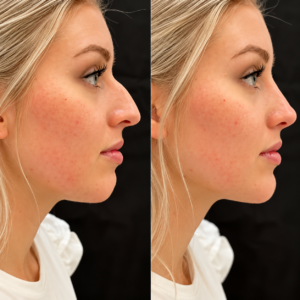facial-before-after-rf-treatment-4